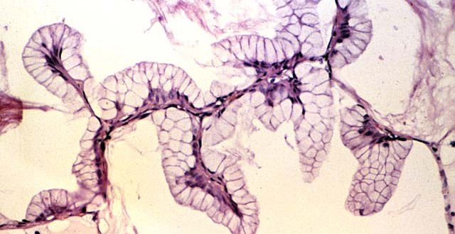 tratamiento del cáncer de próstata de células de avenas tratamiento del cáncer de próstata de células de avenas
