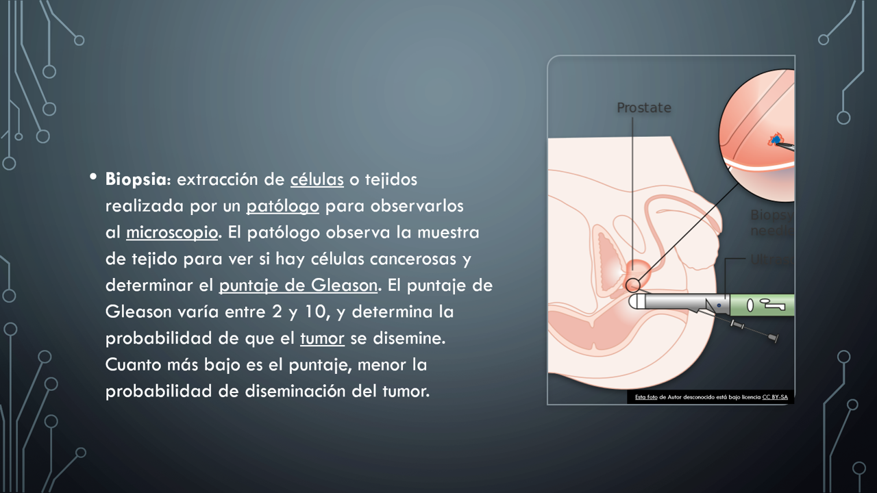 puntajes de análisis de sangre para cáncer de próstata