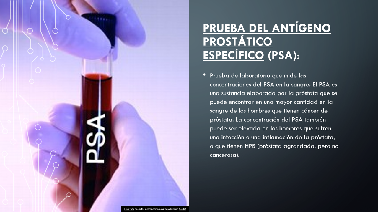 qué mide una prueba de detección de próstatas